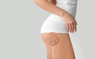 Κυτταρίτιδα – Τι πρέπει να γνωρίζετε