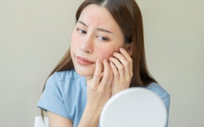 Ροδόχρους Ακμή – Η ακμή των ενηλίκων